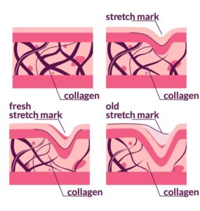 31643865 2205.q802.008.S.m009.c10.stretch marks fp flat infographic scaled e1718333354884