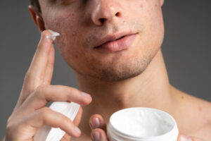 young handsome man using cream acne