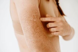 peeling skin after sunburn dermatology 260nw 2322296585