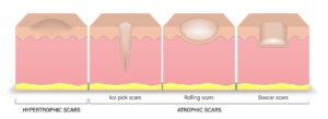 acne scars