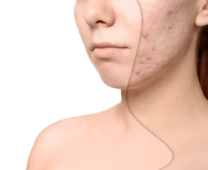 bigstock Young Woman With Acne Problem 253291672